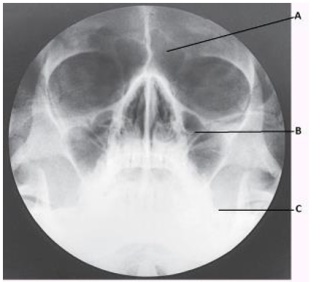 What projection (method) is demonstrated in the image below of the paranasal sinuses?   A)  PA axial (Caldwell)  B)  Parietoacanthial (Waters)  C)  Lateral D)  SMV