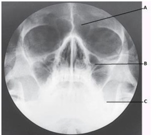 Which paranasal sinuses are labeled with the letter A in this image?   A)  Frontal B)  Ethmoid C)  Maxillary D)  Sphenoid