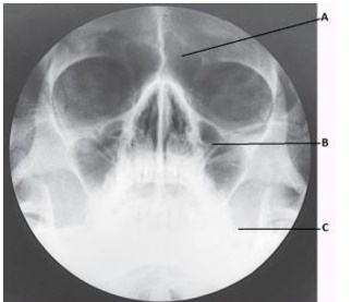 The letter B in the image below of the paranasal sinuses labels the _____ sinuses.   A)  frontal B)  ethmoid C)  maxillary D)  sphenoid