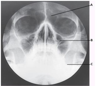The letter C in the image below of the paranasal sinuses labels the:   A)  sphenoid sinuses. B)  condyle of the mandible. C)  petrous ridge. D)  vomer.