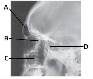 The letter C in the image below of the paranasal sinuses labels the:   A)  sphenoid sinuses. B)  maxillary sinuses. C)  petrous ridge. D)  ethmoid sinuses.