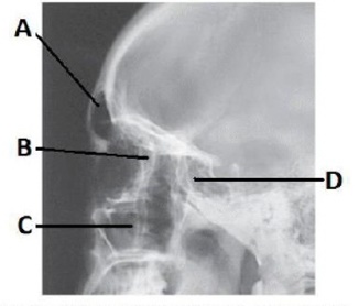 The letter A in the image below of the paranasal sinuses labels the:   A)  frontal sinuses. B)  ethmoid sinuses. C)  sphenoid sinuses. D)  crista galli.