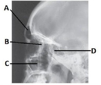 The letter D in the image below of the paranasal sinuses labels the _____ sinuses.   A)  frontal B)  ethmoid C)  sphenoid D)  maxillary