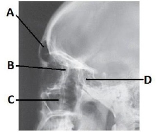 The letter B in the image below of the paranasal sinuses labels the _____ sinuses.   A)  frontal B)  ethmoid C)  sphenoid D)  maxillary