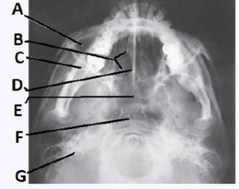The letter D in the image below of the paranasal sinuses labels the:   A)  crista galli. B)  vomer. C)  perpendicular plate of the ethmoid bone. D)  cribriform plate.