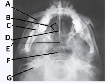 The letter B in the image below of the paranasal sinuses labels the _____ sinuses.   A)  ethmoid B)  sphenoid C)  maxillary D)  frontal