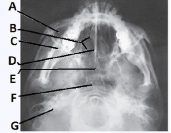 The letter E in the image below of the paranasal sinuses labels the _____ sinuses.   A)  ethmoid B)  sphenoid C)  maxillary D)  frontal