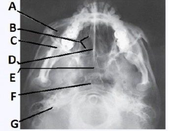 The letter F in the image below of the paranasal sinuses labels the:   A)  ethmoid sinuses. B)  sphenoid sinuses. C)  maxillary sinuses. D)  pharynx.