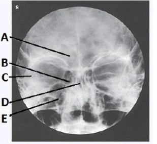 The letter A in the image below of the paranasal sinuses labels the _____ sinuses.   A)  ethmoid B)  sphenoid C)  maxillary D)  frontal