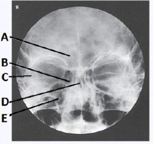 The letter B in the image below of the paranasal sinuses labels the _____ sinuses.   A)  ethmoid B)  sphenoid C)  maxillary D)  frontal