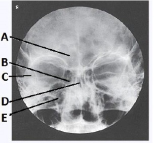The letter C in the image below of the paranasal sinuses labels the:   A)  ethmoid sinuses. B)  sphenoid sinuses. C)  maxillary sinuses. D)  petrous ridge.