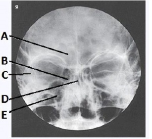 The letter D in the image below of the paranasal sinuses labels the _____ sinuses.   A)  ethmoid B)  sphenoid C)  maxillary D)  frontal
