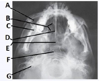 The letter G in the image below of the paranasal sinuses labels the:   A)  ethmoid sinuses. B)  sphenoid sinuses. C)  maxillary sinuses. D)  petrosa.