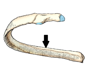 The part of the rib identified in the figure below is the:   A)  body. B)  angle. C)  costal groove. D)  sternal end.