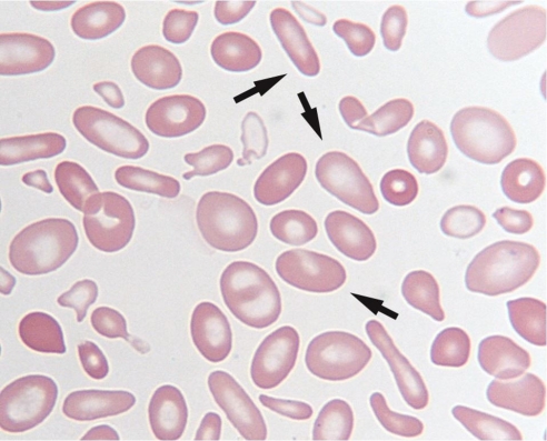 Which poikilocyte is indicated by the arrows in the following image?   A)  Spherocytes B)  Macrocytes C)  Schistocytes D)  Elliptocytes