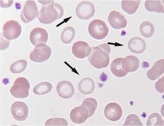 What should be reported about the RBCs indicated by the arrows in the following image?   A)  Hypochromasia B)  Drepanocytes C)  Ovalocytes D)  Macrocytes