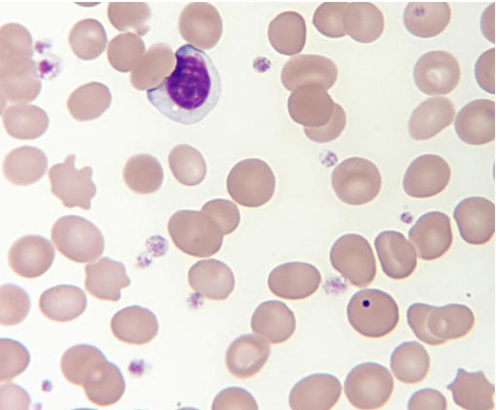 Identify the RBC inclusion in the following image.   A)  Siderotic granule B)  Basophilic stippling C)  Howell Jolly body D)  Heinz body
