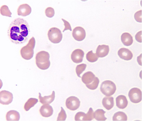 Identify the poikilocytes in the following image and indicate a possible mechanism for their formation.   A)  Stomatocytes; liver disease B)  Elliptocytes; iron deficiency C)  Schisocytes; intravascular damage D)  Codocytes; intracellular defect
