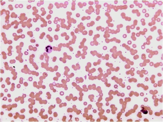 What should be reported about the RBCs in the following image and what affect would this have on the CBC results?   A)  agglutination; increased MCV and decreased RBC count B)  rouleaux; no affect on the CBC results C)  codocytes; increased RBC count D)  spherocytes; increased MCV