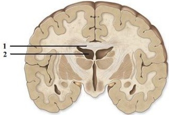 Division, origin, & function of component parts of the brain.   -This figure shows a frontal section of the cerebrum. What structure does number 1 indicate? A)  Central canal B)  Lateral ventricle C)  Brainstem D)  Corpus callosum E)  Fourth ventricle