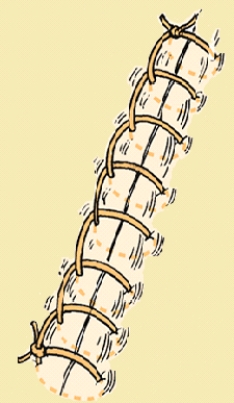 The nurse is preparing to remove a patient's sutures.What technique demonstrates correct technique? A) Snip first suture distal to knot, then snip second suture on the same side. B) Snip suture distal to knot and pull through skin in one smooth motion. C) Place end of suture extractor under suture and pull upwards. D) Pull the exposed suture through the skin and out through the other side.