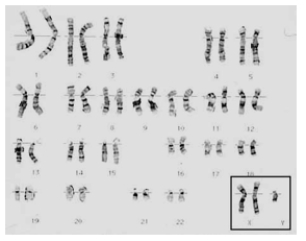 This boy's parents' X chromosomes can be distinguished by polymorphism (DNA fingerprint) differences. One of his mother's X chromosomes has the polymorphism allele 7 and the other has the allele 14; his father's X has the allele 5. Assuming each parent contributed at least one sex chromosome, what polymorphism combinations are possible in the boy's X chromosomes?  