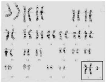 <strong>How many Barr bodies (condensed X chromosomes) would you predict in this boy's cells? </strong> A) one per somatic cell B) two per somatic cell C) three per somatic cell D) none E) either two or three depending on the tissue type
