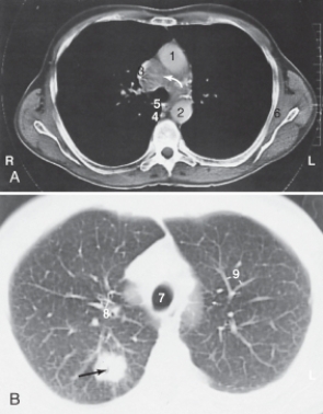 The ascending aorta is labeled:   A) 1. B) 2. C) 5. D) 7.
