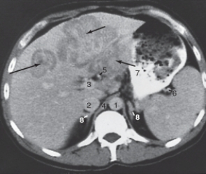 The structure labeled as 2 is the:   A)  aorta. B)  hepatic artery. C)  inferior vena cava (IVC) . D)  portal vein.
