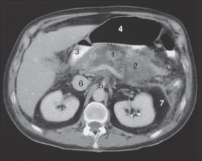 The superior mesenteric artery is labeled:   A) 1. B) 2. C) 3. D) 4.