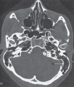 The structure labeled 6 is the:   A)  ascending carotid canal. B)  lateral orbital wall. C)  nasal septum. D)  mandibular condyle.