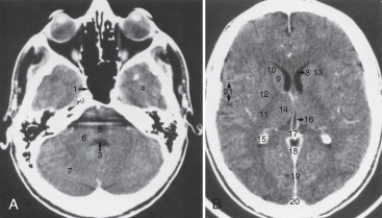 The thalamus is labeled:   A) 9. B) 10. C) 12. D)  14.