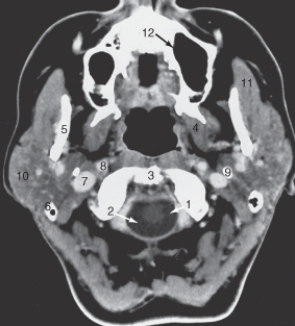 The structure labeled as 1 is the:   A)  internal carotid artery. B)  masseter muscle. C)  odontoid process. D)  spinal cord.