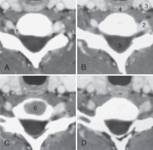 The structure labeled as 4 is the:   A)  carotid artery. B)  esophagus. C)  spinal cord. D)  vertebral artery.