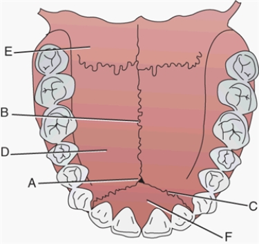 Match each labeled landmark or bone in the following figure to the correct descriptor.   -Intermaxillary suture