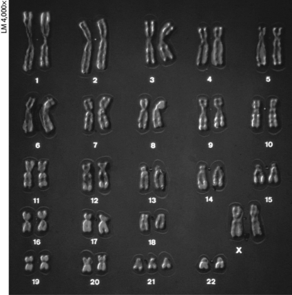   -The karyotype above shows ________. A) abnormal sex chromosomes B) trisomy 21, a cause of Klinefelter syndrome C) Turner syndrome D) trisomy 21, a cause of Down syndrome