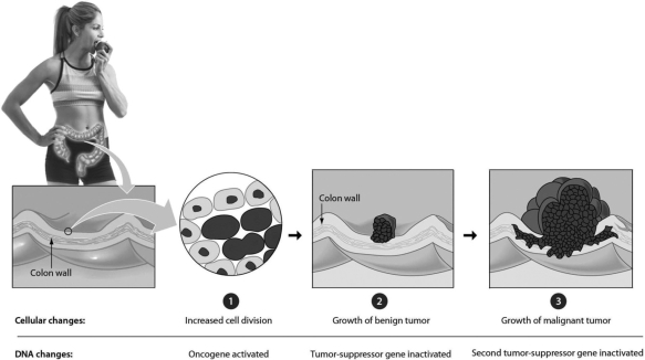 In a typical colon cancer, the first step is ________.   A) the inactivation of a tumor-suppressor gene B) the mutation of a tumor-suppressor gene, producing an oncogene C) the mutation of a proto-oncogene, producing an oncogene D) the conversion of an oncogene to a tumor-suppressor gene