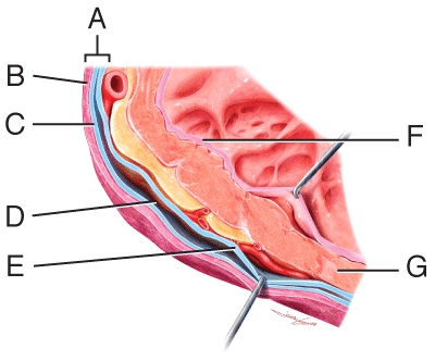 Which labeled structure in the heart wall diagram is responsible for the pumping action of the heart?   A) A B) B C) E D) F E) G