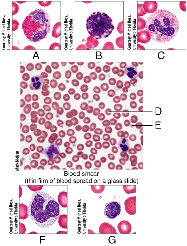 Which of the labeled cells in the photomicrographs contains cytosolic granules that release histamine to intensify the inflammatory response?   A) A B) B C) C D) F E) G
