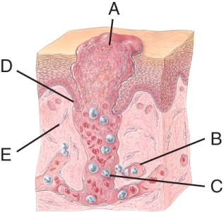 In the given diagram, which label represents the cells that migrate into a deep wound and lay down collagen fibers within the wound to form scar tissue?   A) B B) C C) E D) D E) A