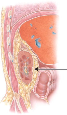 What structure is the arrow is pointing to?   A)  suprarenal gland B)  adipose capsule C)  quadratus lumborum D)  peritoneum
