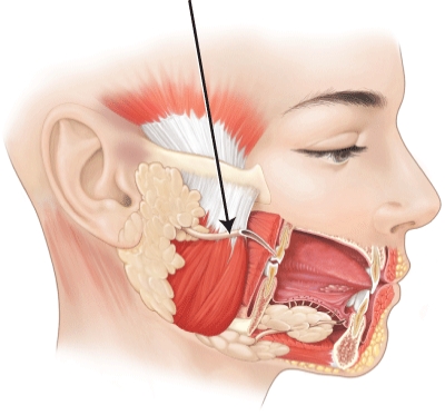 What structure is the arrow is pointing to?   A)  parotid duct B)  mylohyoid duct C)  submandibular duct D)  sublingual duct
