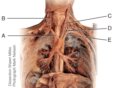 Which of these vessels of the neck contributes directly to the formation of the basilar artery?   A)  A B)  B C)  C D)  D