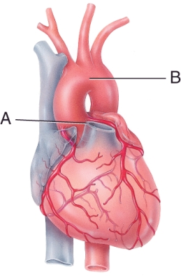 <strong>Match the vessel with the description. Aorta: </strong> A) carries oxygenated blood away from the heart B) carries deoxygenated blood away from the heart