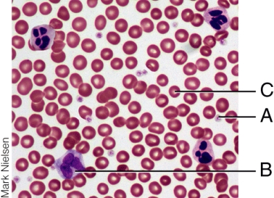 Which cell type is involved in the condition known as Thrombocytopenia?   A)  A B)  B C)  C D)  All of the choices are correct.
