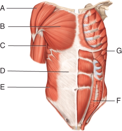 <strong>The muscle indicated by line G </strong> A) depresses the scapula B) abducts the sapula C) inserts on the lateral border D) is innervated by the dorsal scapular nerve E) is the swimmer's muscle