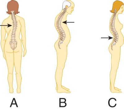 <strong>Which of the following exhibits an abnormal kyphotic curvature of the spine? </strong> A) A B) B C) C