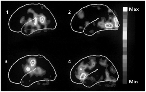   Which of the PET images above shows high levels of activity in the occipital lobe? A) 1 B) 2 C) 3 D) 4