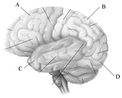   -Cortical deafness is a rare form of hearing loss where the patient is unable to hear sounds without any damage to the anatomy of the ear.What lobe is most affected in cortical deafness? A) A B) B C) C D) D