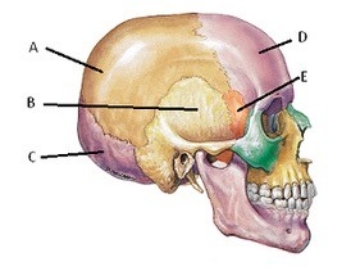   -Which of the following is represented by  E ? A)  Frontal bone B)  Occipital bone C)  Parietal bone D)  Sphenoid bone E)  Temporal bone
